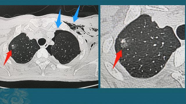 肺结节是怎么长出来的 医生用ct片详解 有2种可能是肺癌 腾讯新闻