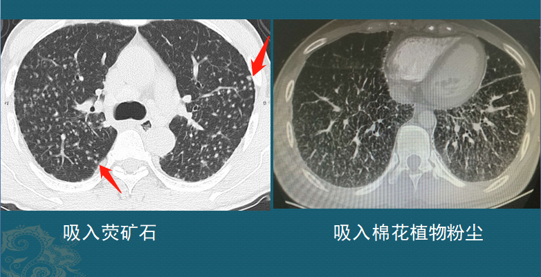 肺结节是怎么长出来的?医生用ct片详解,有2种可能是肺癌