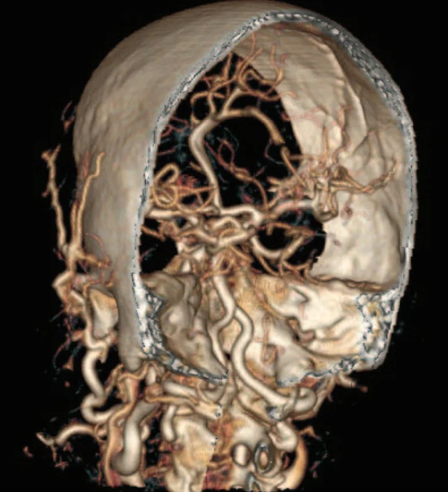 脑血管三维成像图片