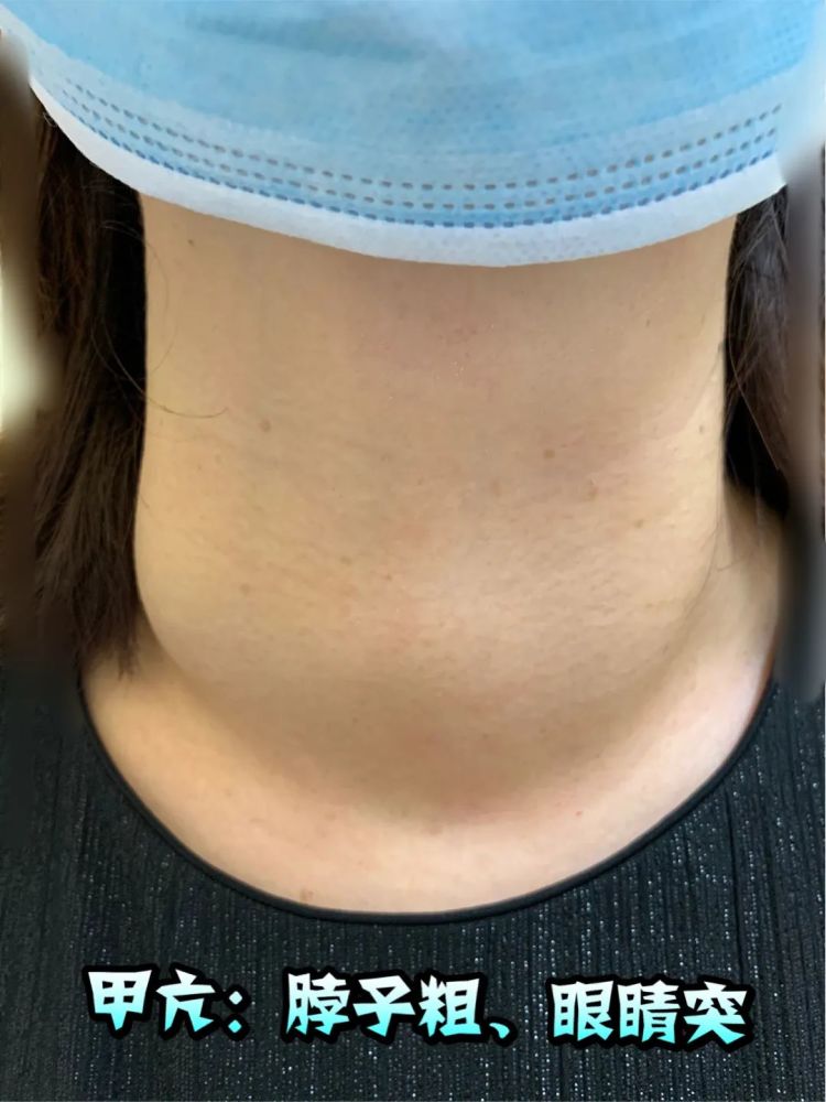 门诊再遇脖子粗眼球突典型甲亢者