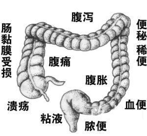 結腸炎患者拉肚子便血不能吃涼的小崔醫生講潰瘍性結腸炎