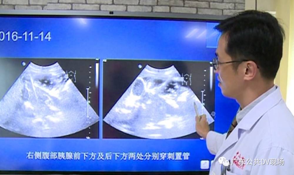 暴饮暴食|小伙暴饮暴食却瘦了八十多斤，他说再也不敢了！