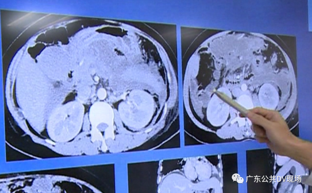 暴饮暴食|小伙暴饮暴食却瘦了八十多斤，他说再也不敢了！