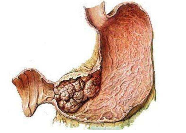 胃癌症状图片早期图片