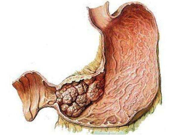 胃窦腺癌图片
