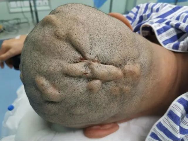 科室传真小伙身患毛囊闭锁三联征苦不堪言市中研附院外科专家妙手回春