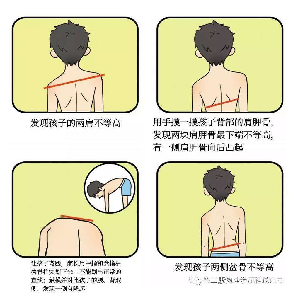 你家孩子脊柱歪67了吗对照这几大指标快自查一下