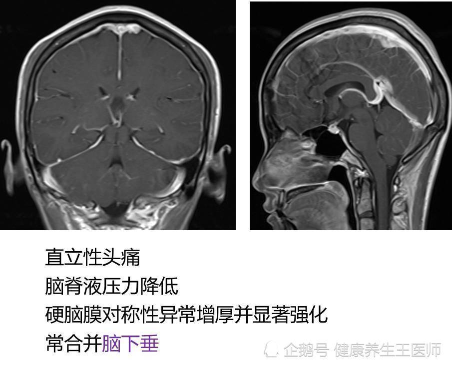 低颅压性头痛