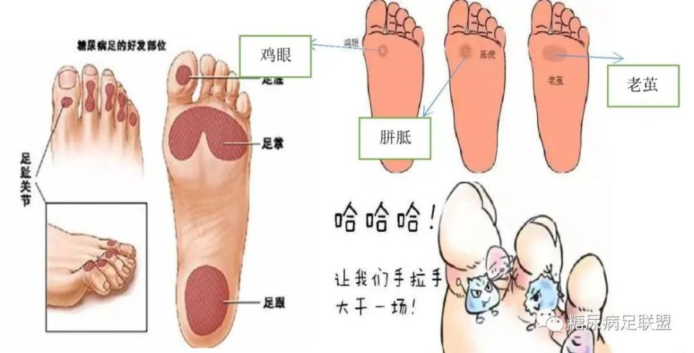 防大于治 糖友 须知 六招自我检测糖尿病足的方法 腾讯新闻