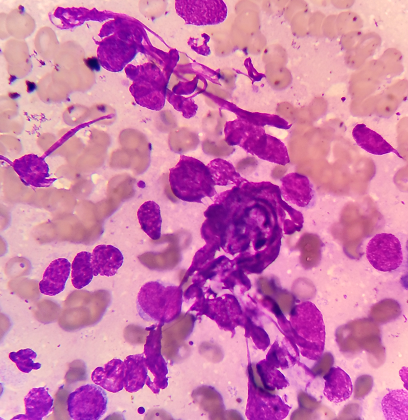 刷检物中的异常细胞