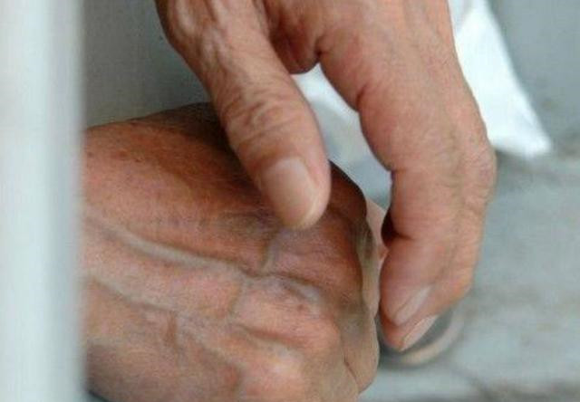 手上青筋越多的人说明身体素质越差吗来看看医生是怎么说的