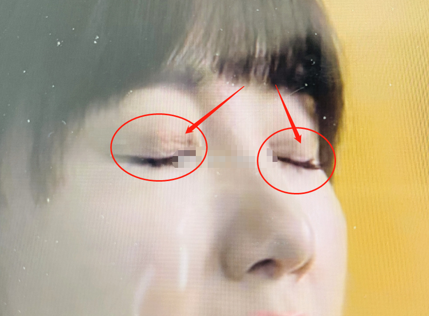 毛晓彤|毛晓彤被曝整容？Baby化妆师吐槽她整容医生不行，眼角开口出现后遗症