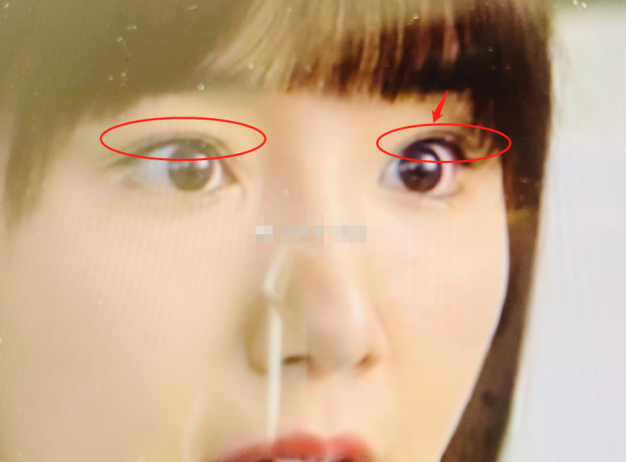 毛晓彤|毛晓彤被曝整容？Baby化妆师吐槽她整容医生不行，眼角开口出现后遗症