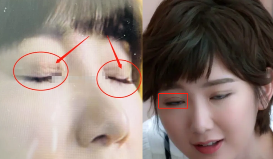 毛晓彤|毛晓彤被曝整容？Baby化妆师吐槽她整容医生不行，眼角开口出现后遗症