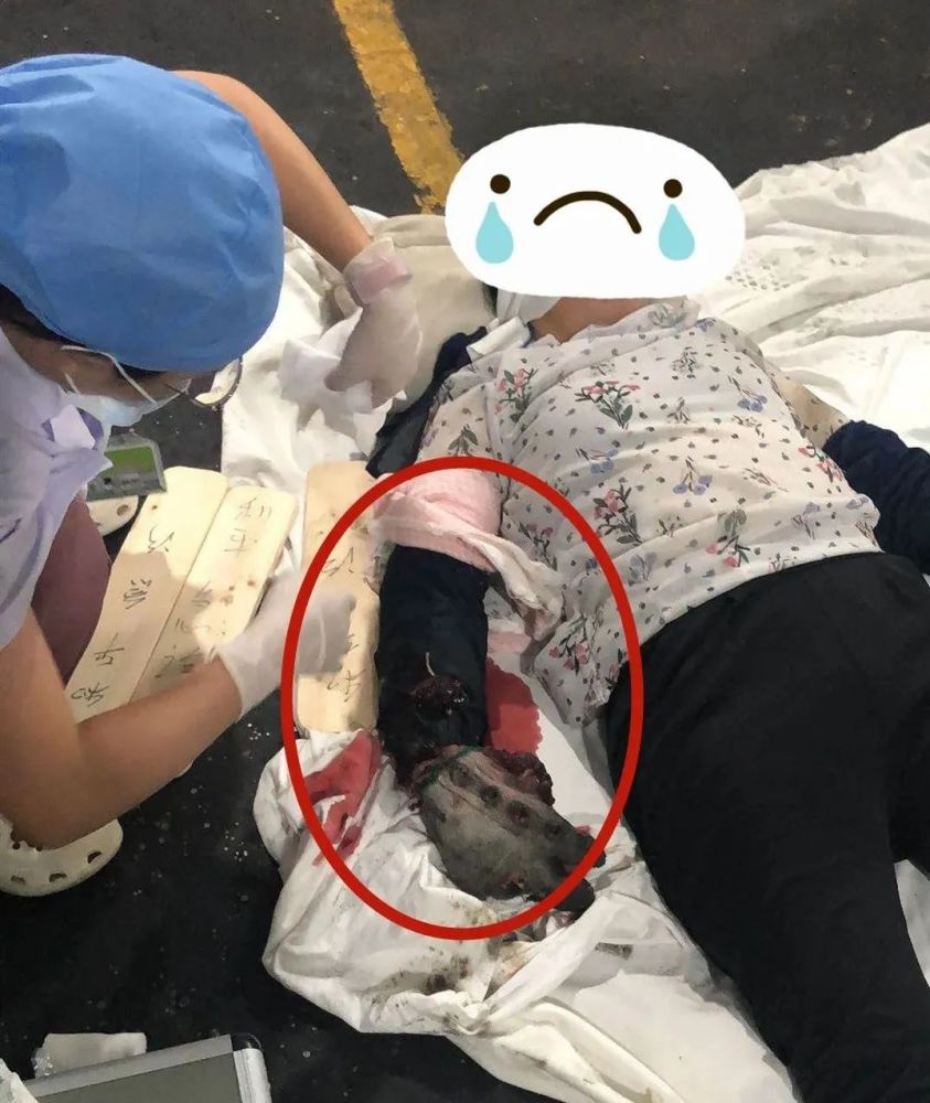 顺德一女子手臂被机器压伤血肉模糊