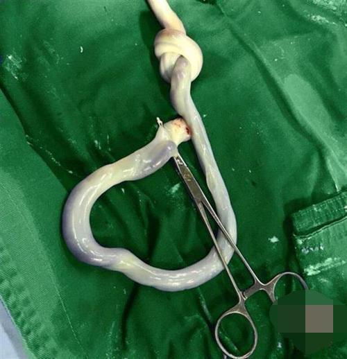 孕8月胎动突然消失,紧急剖腹产时,医生发现脐带扭得像"麻花"