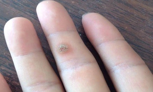 常见的皮肤"疣"有哪些?该怎么治疗?