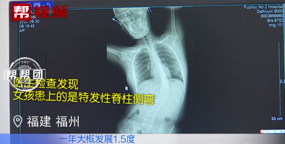11岁女孩高低肩,医生检查后竟发现……_腾讯新闻