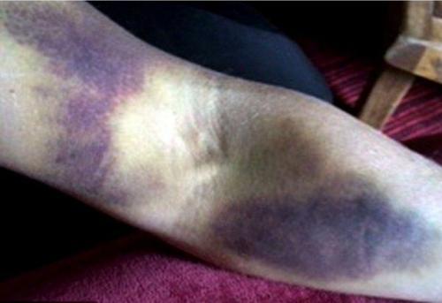 人死后身体为何出现"尸斑"?殡仪馆告诉你真相,看完后长见识了