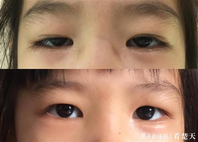 6岁女童从小眯眯眼因自卑一度寡言少语二次手术后重拾自信