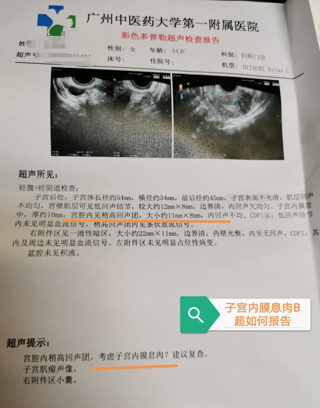 子宮內膜息肉怎麼可以檢查出來確診?會影響懷孕嗎?有什麼症狀?