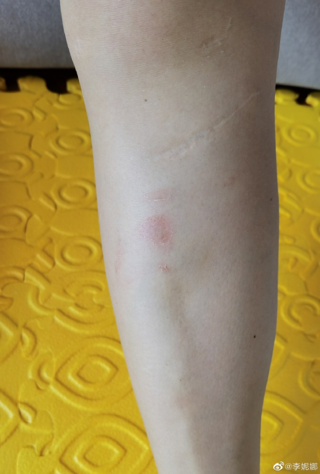 滑雪女神小腿两道伤疤太醒目曾是中国雪上第一人嫁大14岁富豪