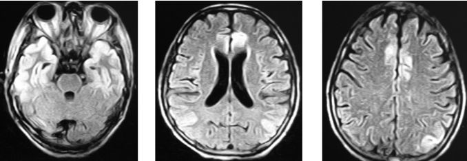 图2头颅mri:双侧额颞枕叶可见长t2(图2),flair呈高信号异常(图3).