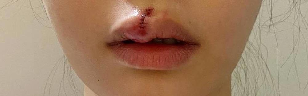 庆幸香港女歌手嘴唇缝针伤口愈合快坦言恢复后要报复性吃东西