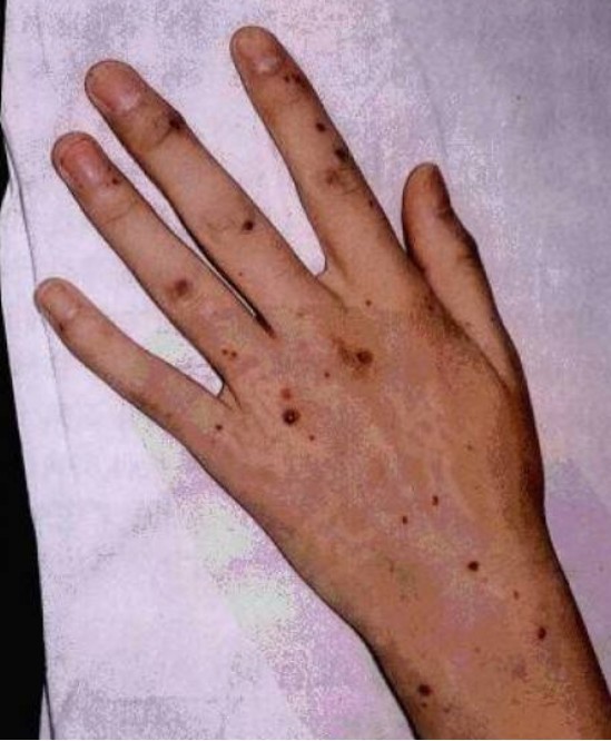 一串鱿鱼让7岁女孩旧病复发,时隔4年一时忘记,医生:要注意