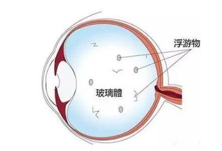 如何给眼睛 驱蚊 带您了解飞蚊症 腾讯网