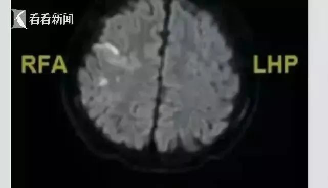 脑梗塞|14岁男孩突发脑梗，凶手竟然是它！这东西危害太大，一口从上到下毁全身