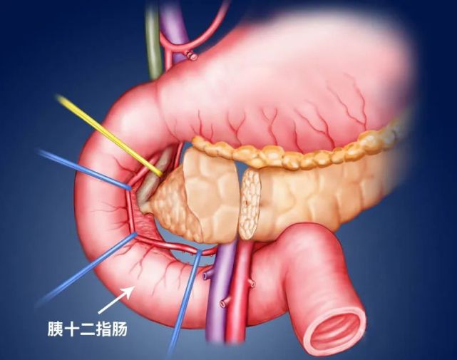 胰十二指肠图片