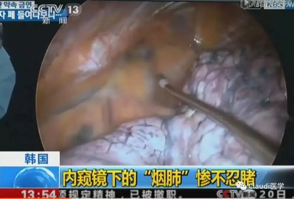 "看完吸烟者的肺,才知道有3亿人在悄悄花钱买死"_腾讯新闻