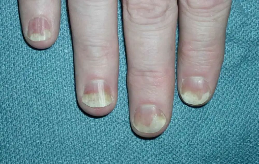 行医笔记全面认识甲分离