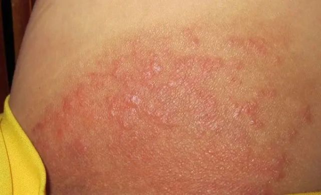 艾灸后皮肤瘙痒,出水泡,肚脐出黄水,这是艾灸后遗症呢?