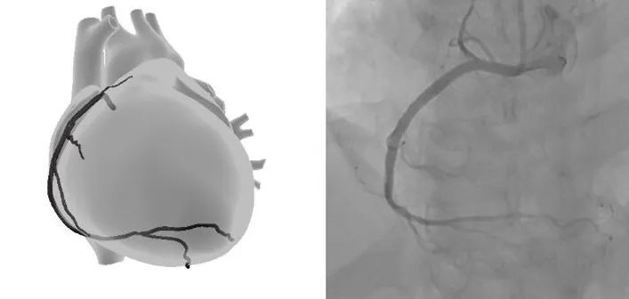 lao45°右冠成像模型与血管造影对照示意图.
