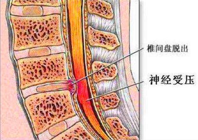 腰椎間盤突出症的患者醫生憑什麼說你要手術