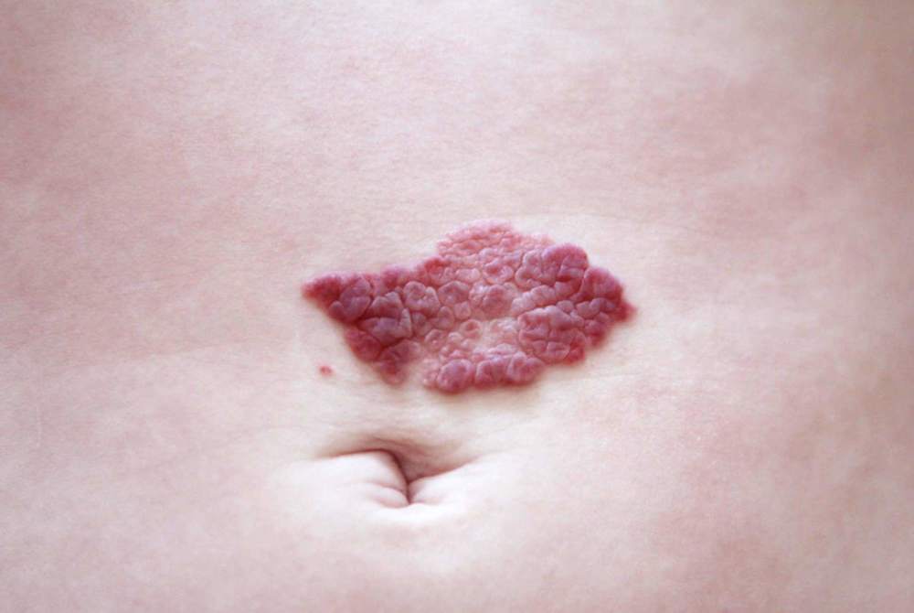 新生儿额头现"心形胎记",天使之吻还是恶魔印记?要能分得清