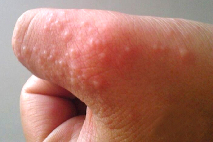 夏天到了手足反复脱皮这种汗疱疹最好内外兼治