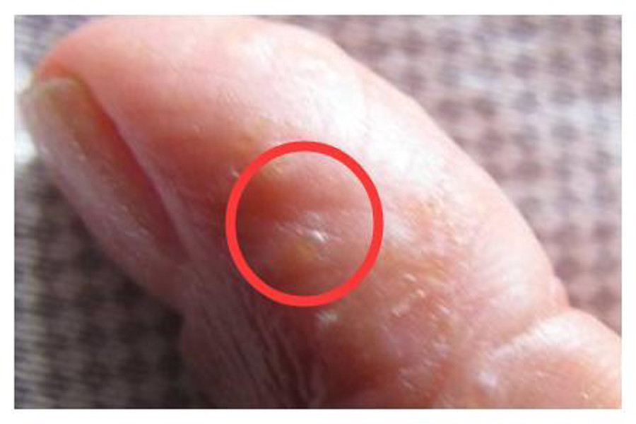 夏天到了手足反复脱皮这种汗疱疹最好内外兼治