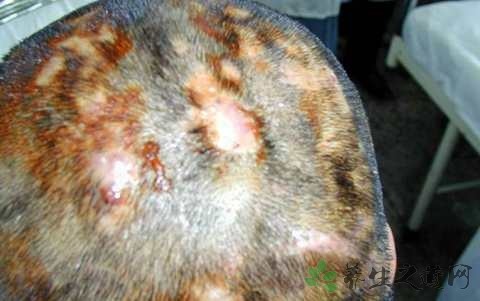 小儿头疖的症状有哪些