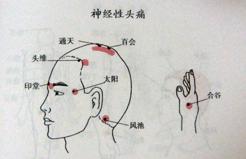 神经性头疼的按摩手法