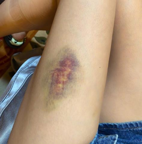 沈梦辰的腿部受伤颜色变成了深紫色网友隔空喊话杜海涛