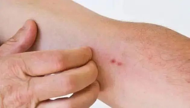 长期高血糖会引起神经纤维不同程度的萎缩,致使神经功能异常,出现皮肤