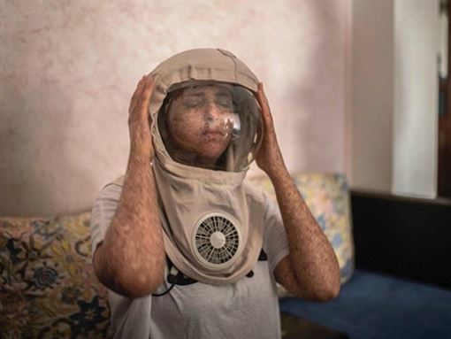 过敏|女孩对阳光过敏 20多年来只要出门就得戴太空面罩