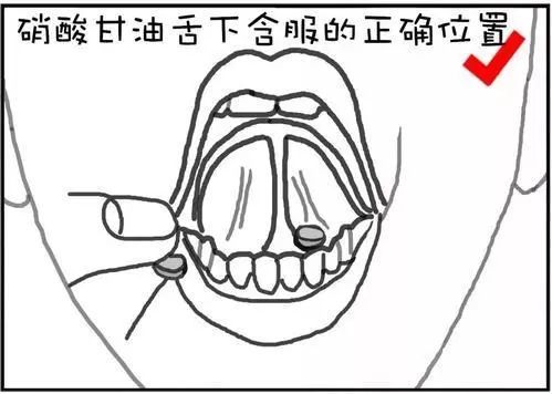 硝酸甘油的正确服用方法是 舌下含服,在这个过程中,患者会有涩辣,灼