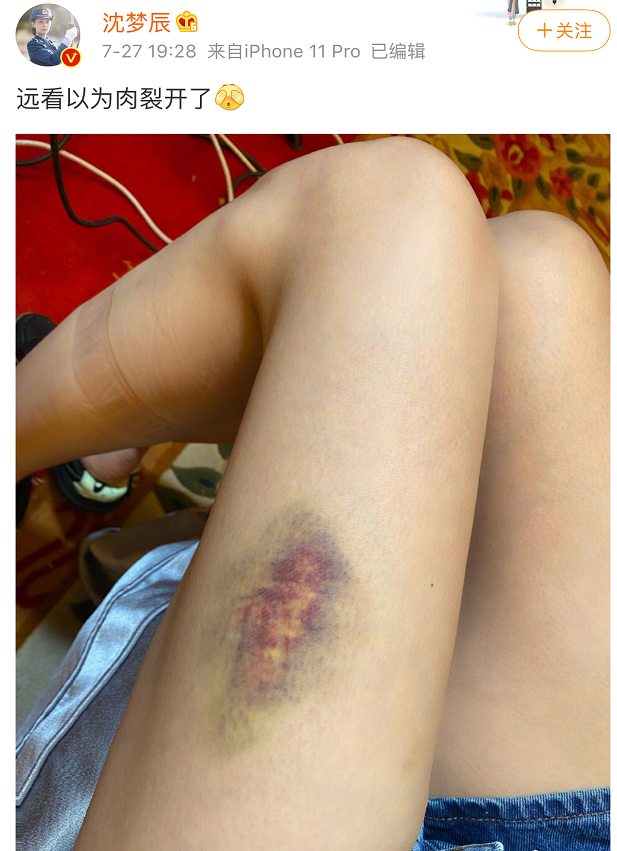 沈梦辰晒大腿淤青照,杨迪火速关切询问,网友:杜海涛又要吃醋了