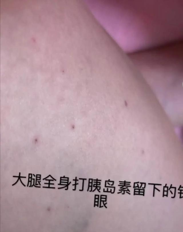 一天四次的胰岛素,自己扎大腿,大腿上密密麻麻的针眼,看了就让人触目