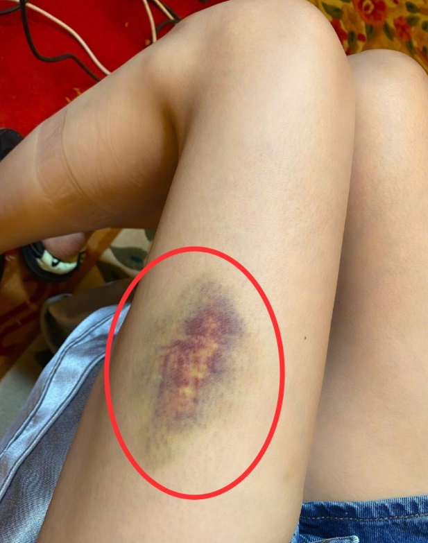 从照片当中看沈梦辰受伤的地方是大腿的位置,真的有点触目惊心,就连沈