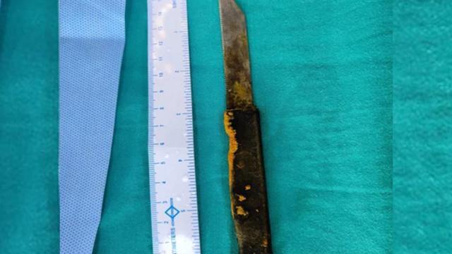 内脏|印男子吞下20厘米刀，1个半月后入诊，内脏竟未受到严重伤害